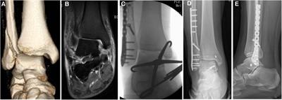 Repair of deep <mark class="highlighted">deltoid</mark> ligament ruptures near the medial malleolar attachment or midsubstance rupture by using suture anchors into the talus combined with the transosseous suture in the medial malleolar